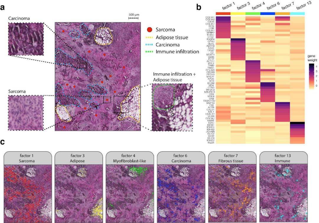 FFPE空間轉(zhuǎn)錄組解析卵巢癌肉瘤免疫浸潤(rùn)過(guò)程[4]